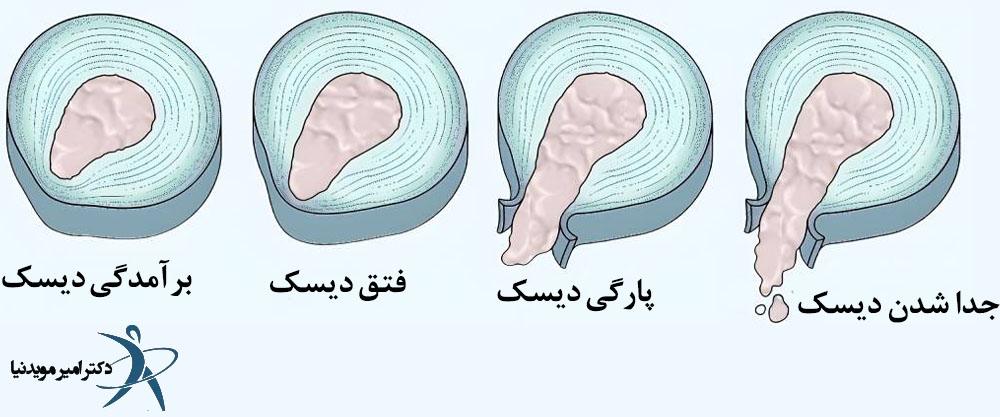 شدت بیرون زدگی دیسک گردن