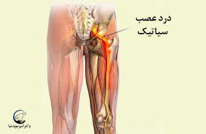 درد سیاتیک