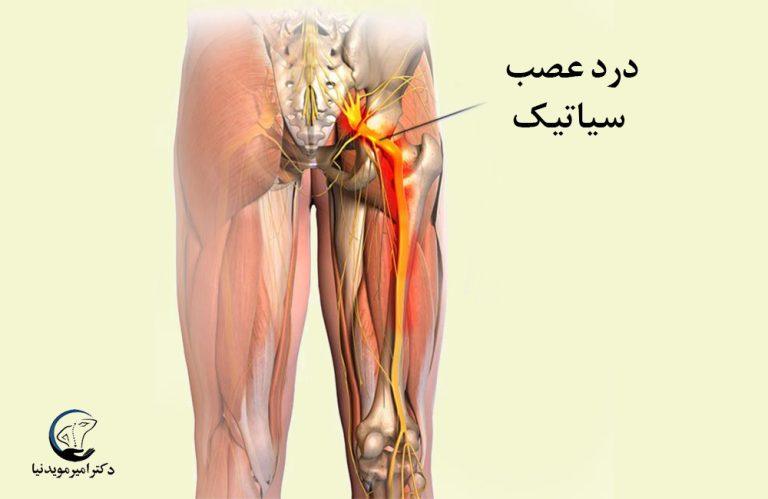 درد سیاتیک