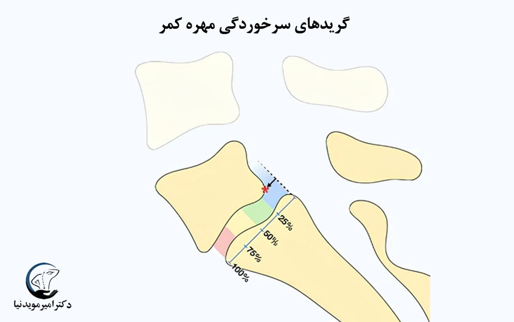 گریدهای سرخوردگی مهره کمر 