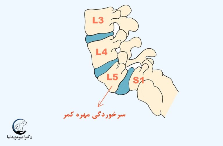 سرخوردگی مهره کمر