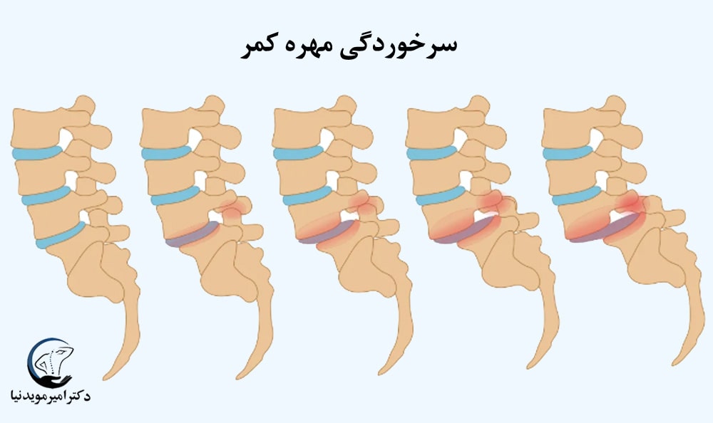 سرخوردگی مهره کمر 