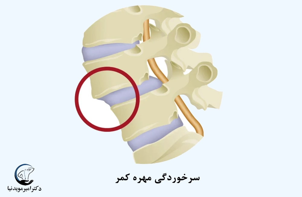 سرخوردگی مهره کمر 